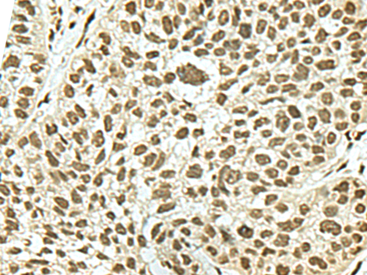 Immunohistochemistry of paraffin-embedded Human esophagus cancer tissue  using KHSRP Polyclonal Antibody at dilution of 1:50(×200)