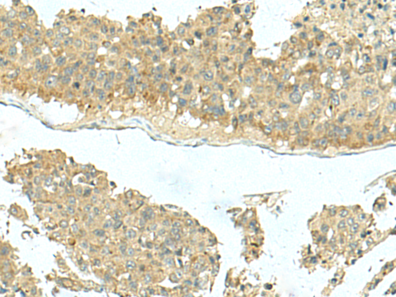 Immunohistochemistry of paraffin-embedded Human liver cancer tissue  using KIR2DL5A Polyclonal Antibody at dilution of 1:40(×200)