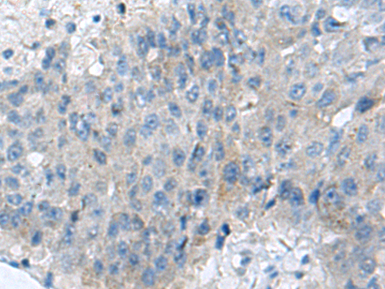 Immunohistochemistry of paraffin-embedded Human liver cancer tissue  using KIAA0556 Polyclonal Antibody at dilution of 1:70(×200)