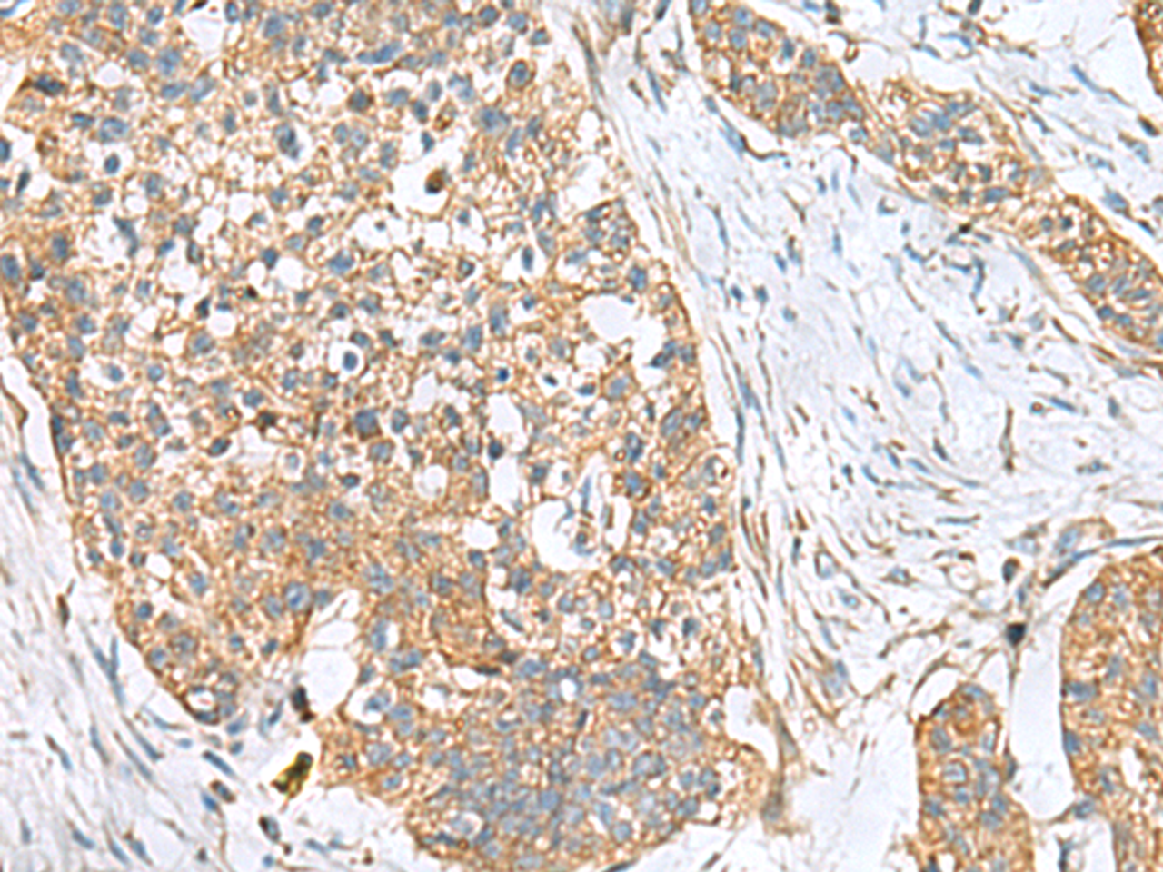 Immunohistochemistry of paraffin-embedded Human esophagus cancer tissue  using CEMIP Polyclonal Antibody at dilution of 1:120(×200)