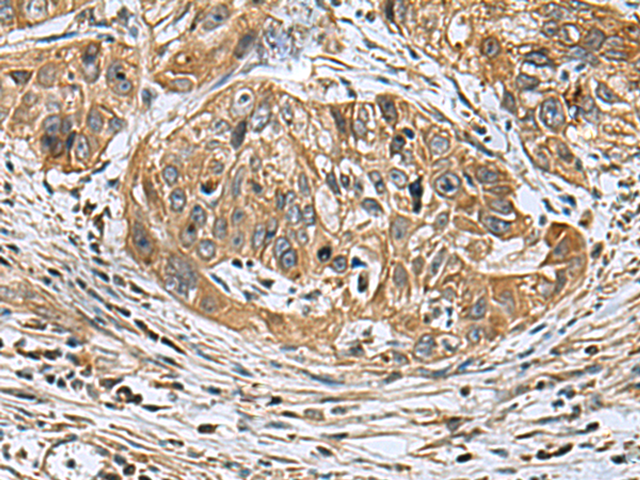Immunohistochemistry of paraffin-embedded Human esophagus cancer tissue  using EARS2 Polyclonal Antibody at dilution of 1:30(×200)