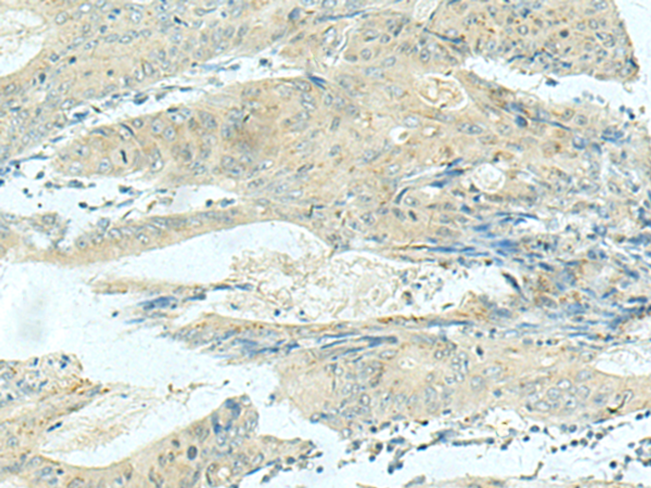 Immunohistochemistry of paraffin-embedded Human colorectal cancer tissue  using KIF21B Polyclonal Antibody at dilution of 1:40(×200)