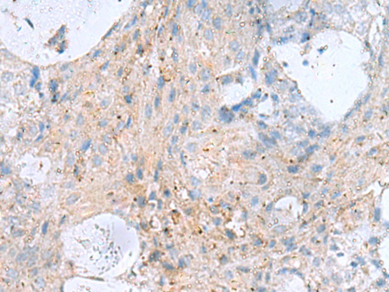 Immunohistochemistry of paraffin-embedded Human ovarian cancer tissue  using KIF5A Polyclonal Antibody at dilution of 1:30(×200)
