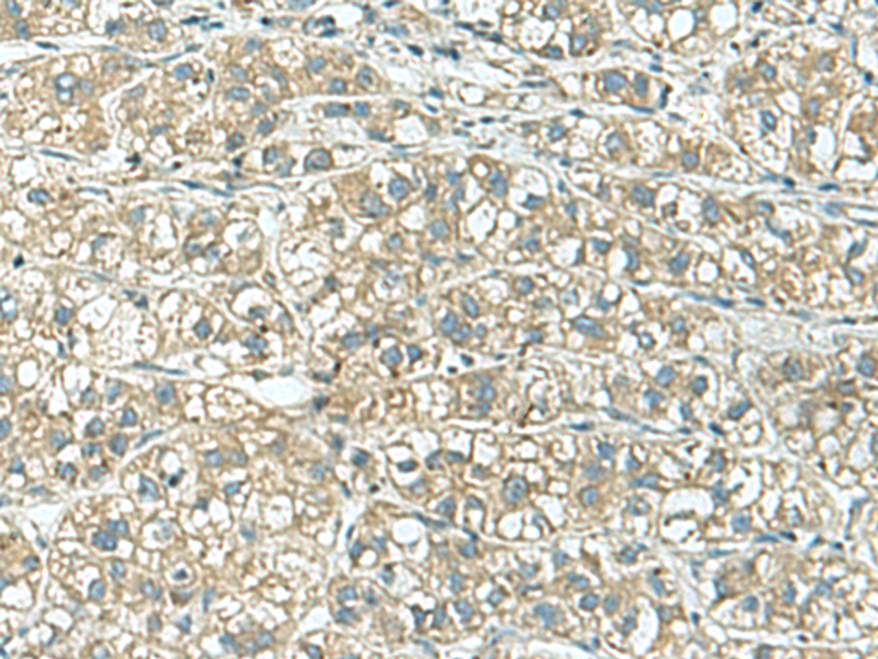 Immunohistochemistry of paraffin-embedded Human liver cancer tissue  using KCNJ2 Polyclonal Antibody at dilution of 1:25(×200)