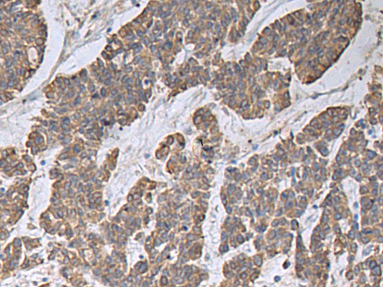 Immunohistochemistry of paraffin-embedded Human colorectal cancer tissue  using CCNF Polyclonal Antibody at dilution of 1:30(×200)