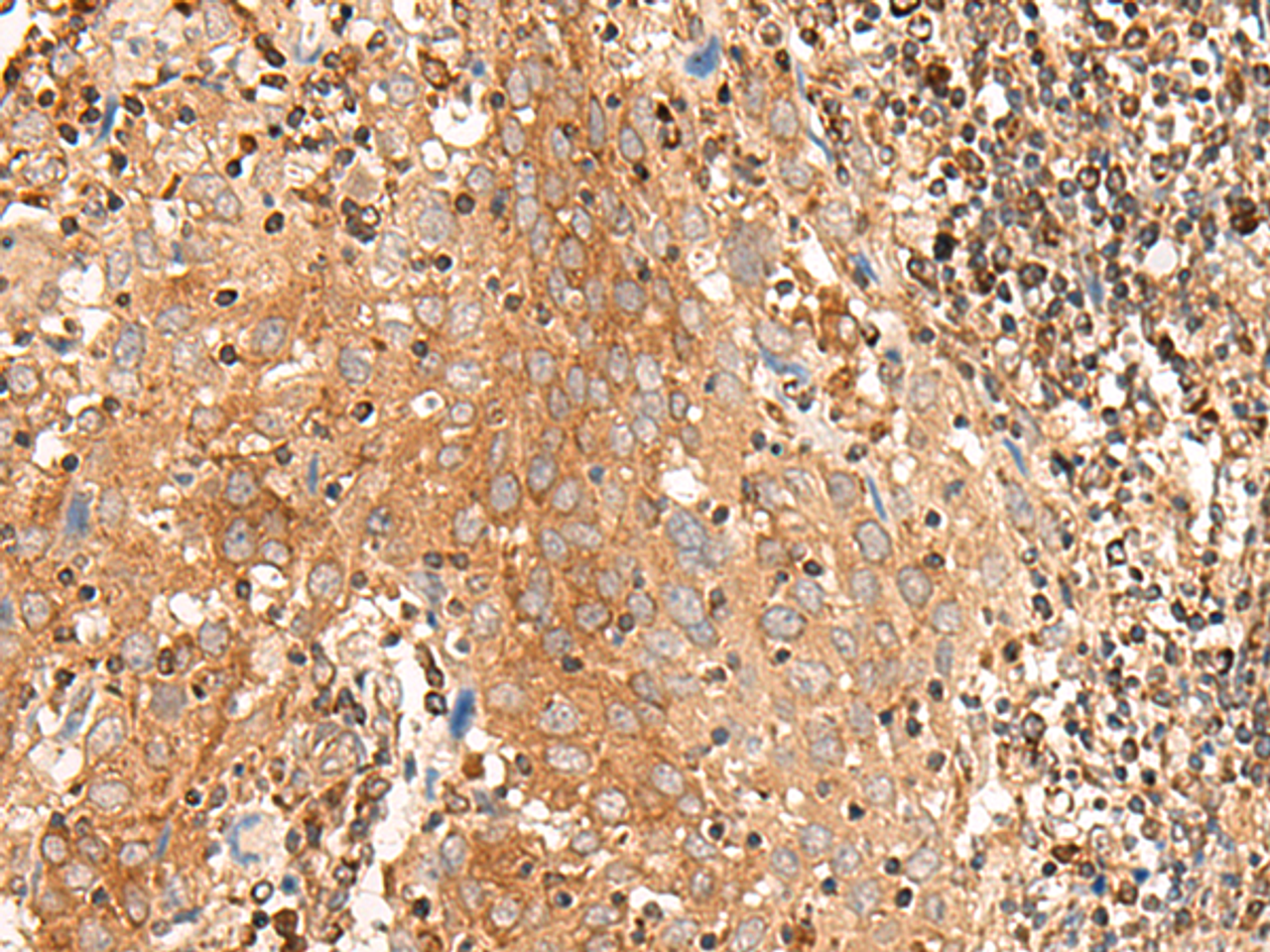 Immunohistochemistry of paraffin-embedded Human cervical cancer tissue  using BAG3 Polyclonal Antibody at dilution of 1:35(×200)