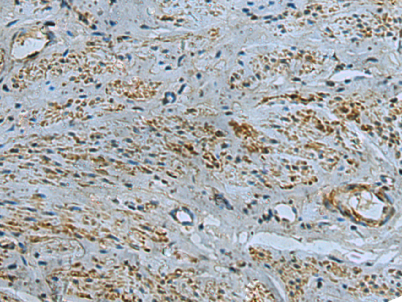 Immunohistochemistry of paraffin-embedded Human cervical cancer tissue  using IL17RD Polyclonal Antibody at dilution of 1:40(×200)
