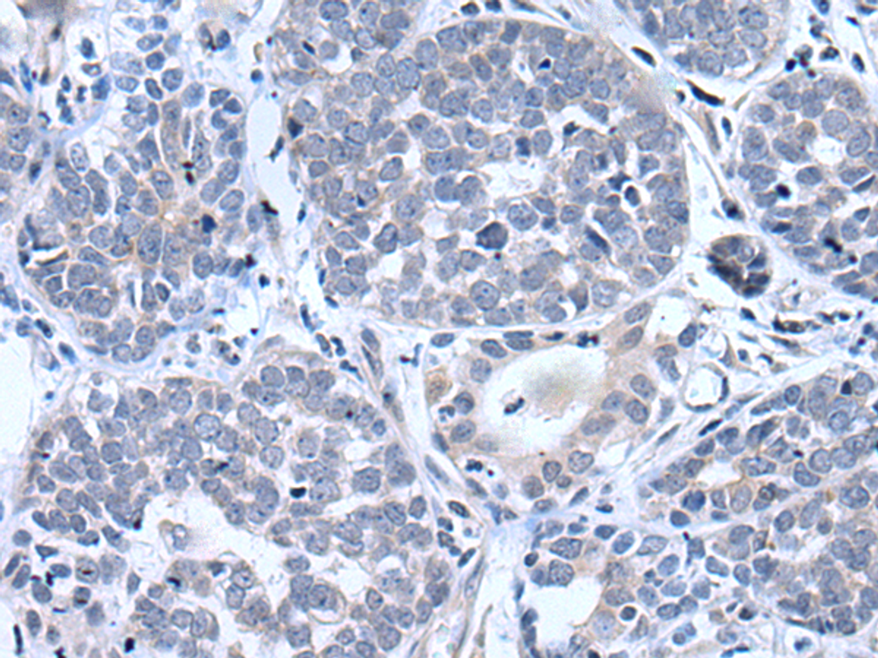 Immunohistochemistry of paraffin-embedded Human esophagus cancer tissue  using BTG4 Polyclonal Antibody at dilution of 1:55(×200)