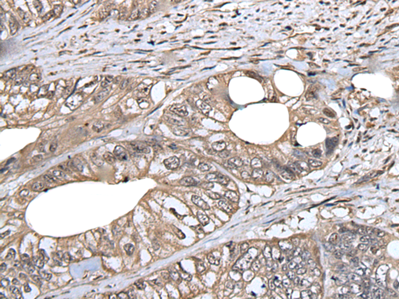 Immunohistochemistry of paraffin-embedded Human colorectal cancer tissue  using DLK1 Polyclonal Antibody at dilution of 1:30(×200)