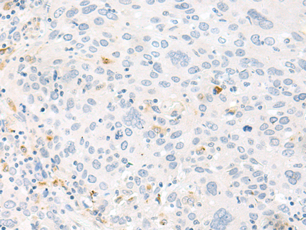Immunohistochemistry of paraffin-embedded Human cervical cancer tissue  using FABP4 Polyclonal Antibody at dilution of 1:60(×200)