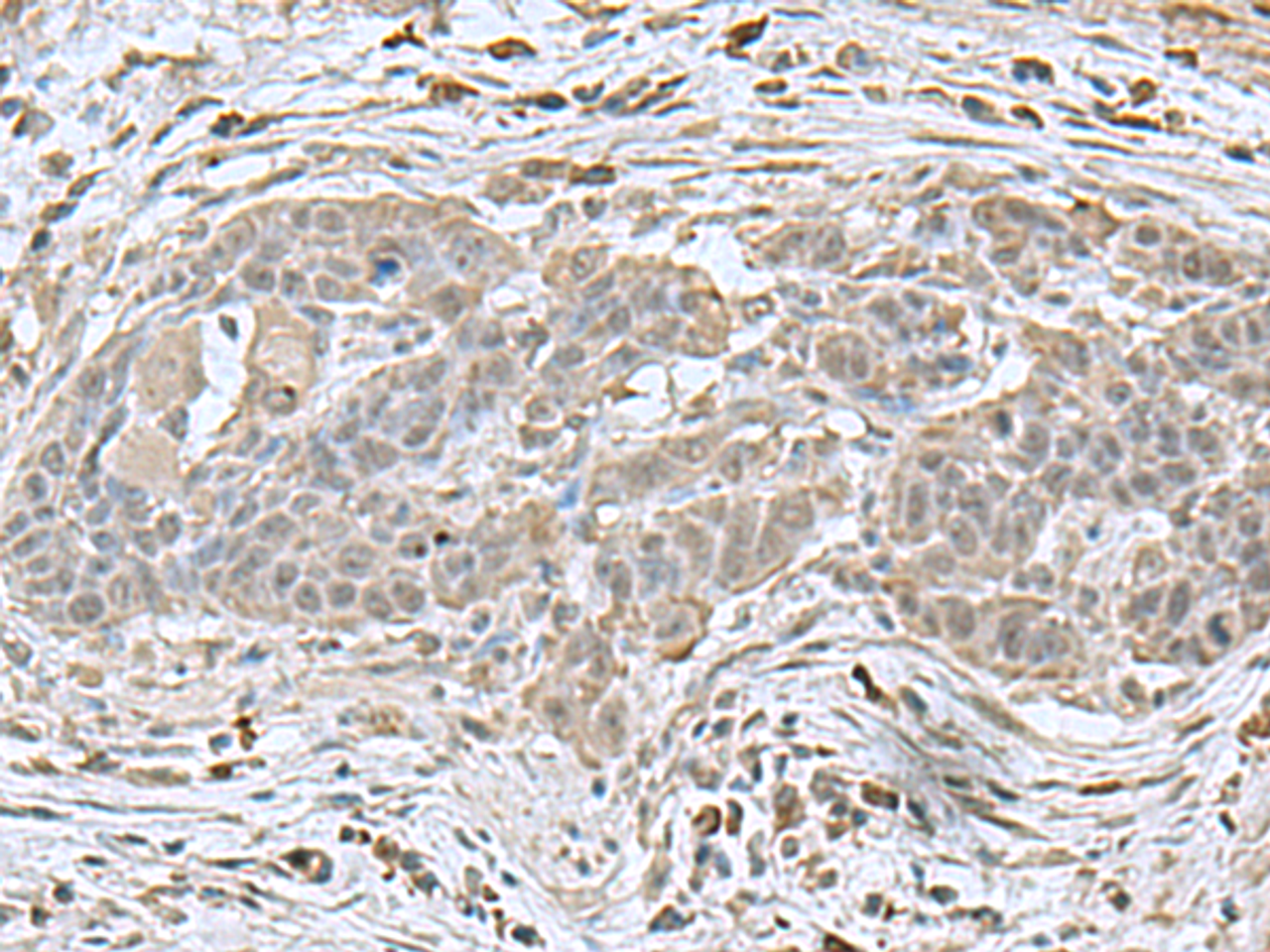 Immunohistochemistry of paraffin-embedded Human esophagus cancer tissue  using NEUROG3 Polyclonal Antibody at dilution of 1:70(×200)