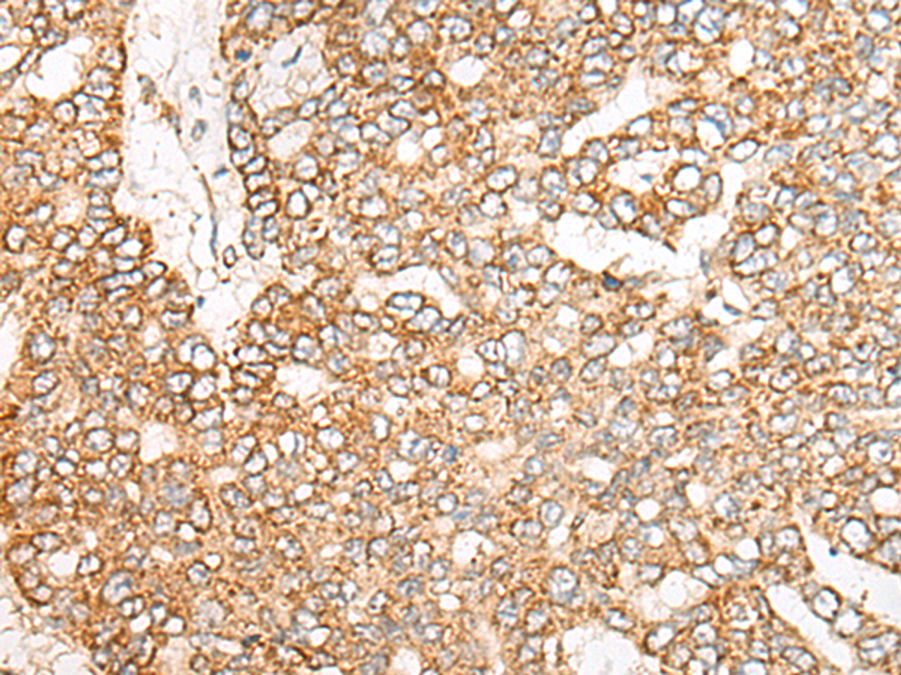 Immunohistochemistry of paraffin-embedded Human liver cancer tissue  using NME4 Polyclonal Antibody at dilution of 1:45(×200)