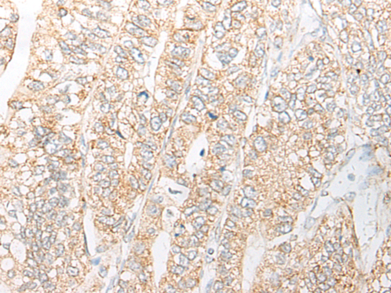 Immunohistochemistry of paraffin-embedded Human gastric cancer tissue  using NME4 Polyclonal Antibody at dilution of 1:45(×200)