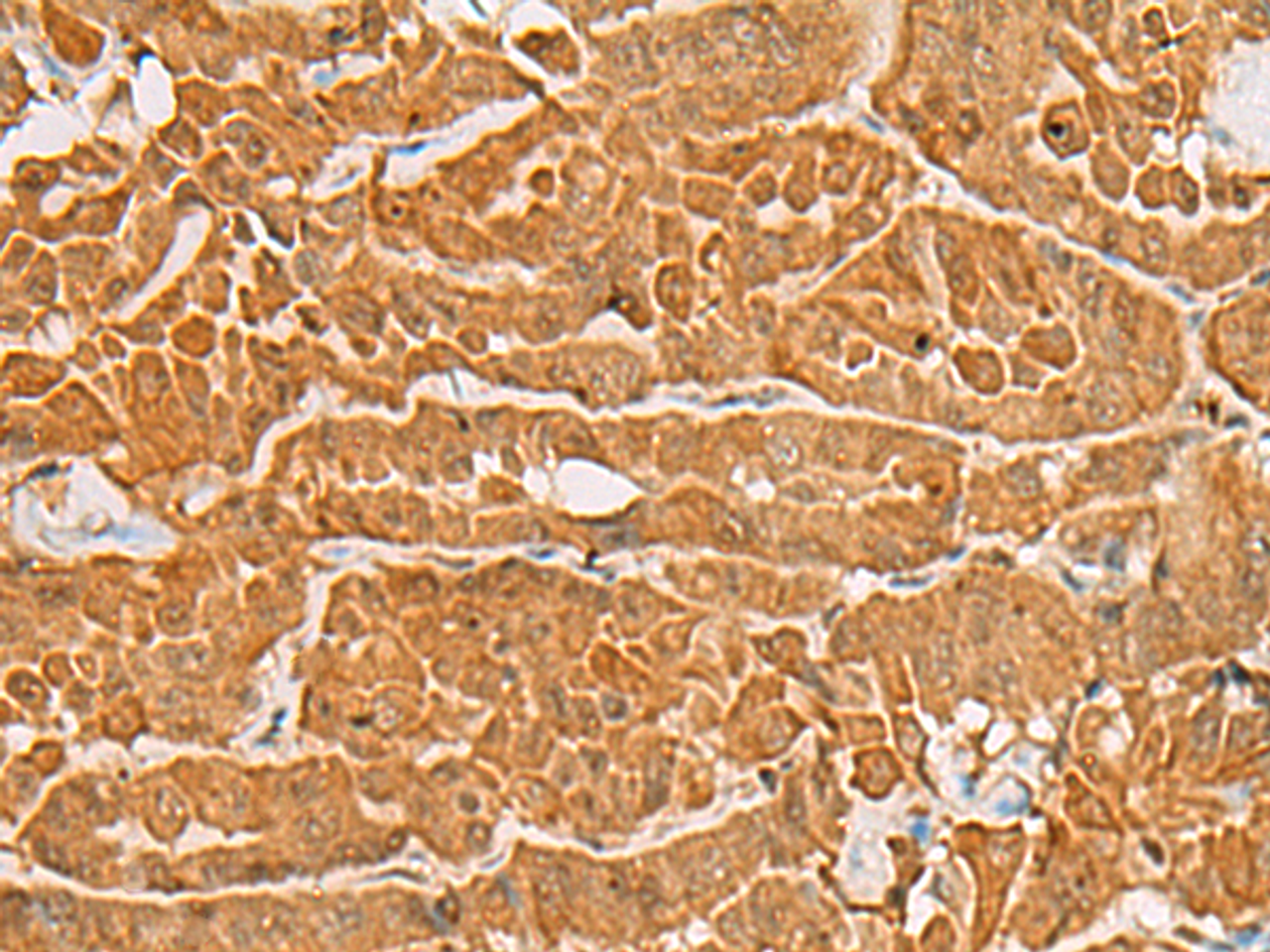 Immunohistochemistry of paraffin-embedded Human thyroid cancer tissue  using MAPK14 Polyclonal Antibody at dilution of 1:60(×200)