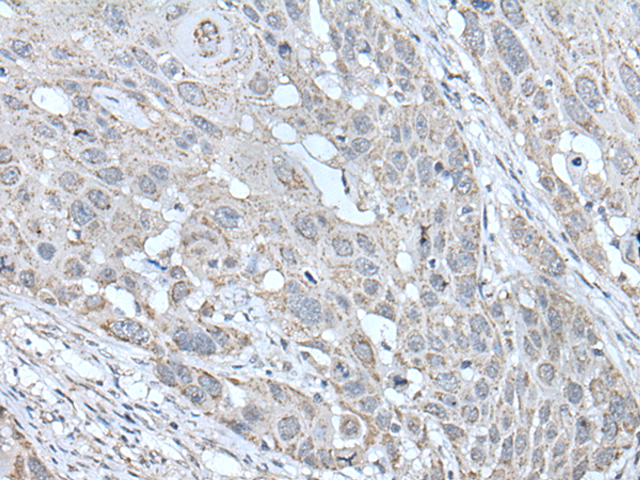 Immunohistochemistry of paraffin-embedded Human esophagus cancer tissue  using SCNN1G Polyclonal Antibody at dilution of 1:40(×200)