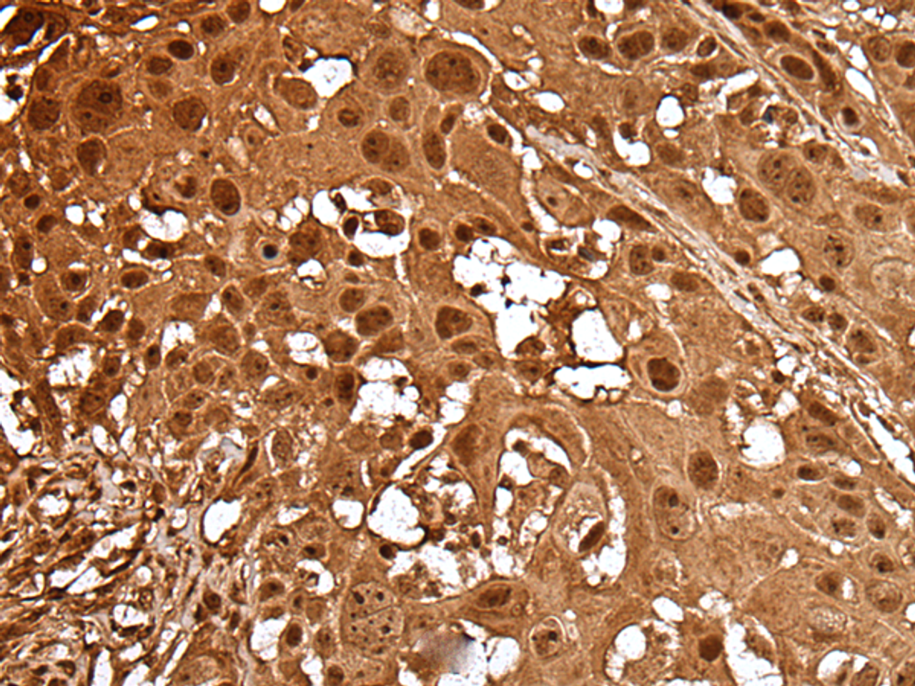 Immunohistochemistry of paraffin-embedded Human esophagus cancer tissue  using LAMTOR5 Polyclonal Antibody at dilution of 1:35(×200)