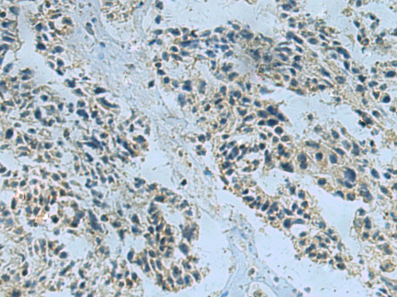 Immunohistochemistry of paraffin-embedded Human ovarian cancer tissue  using NDUFA2 Polyclonal Antibody at dilution of 1:40(×200)