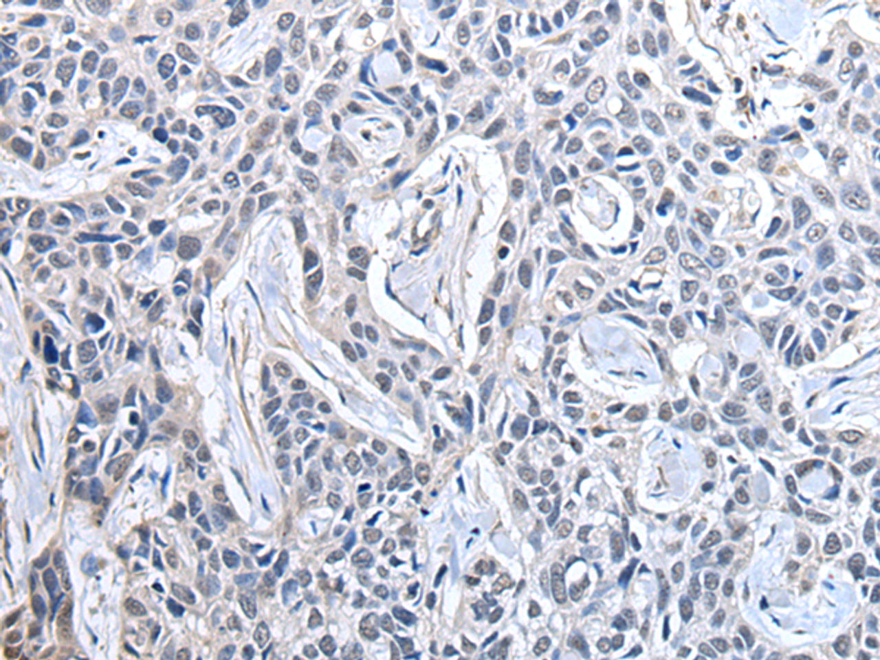 Immunohistochemistry of paraffin-embedded Human lung cancer tissue  using PPIG Polyclonal Antibody at dilution of 1:50(×200)