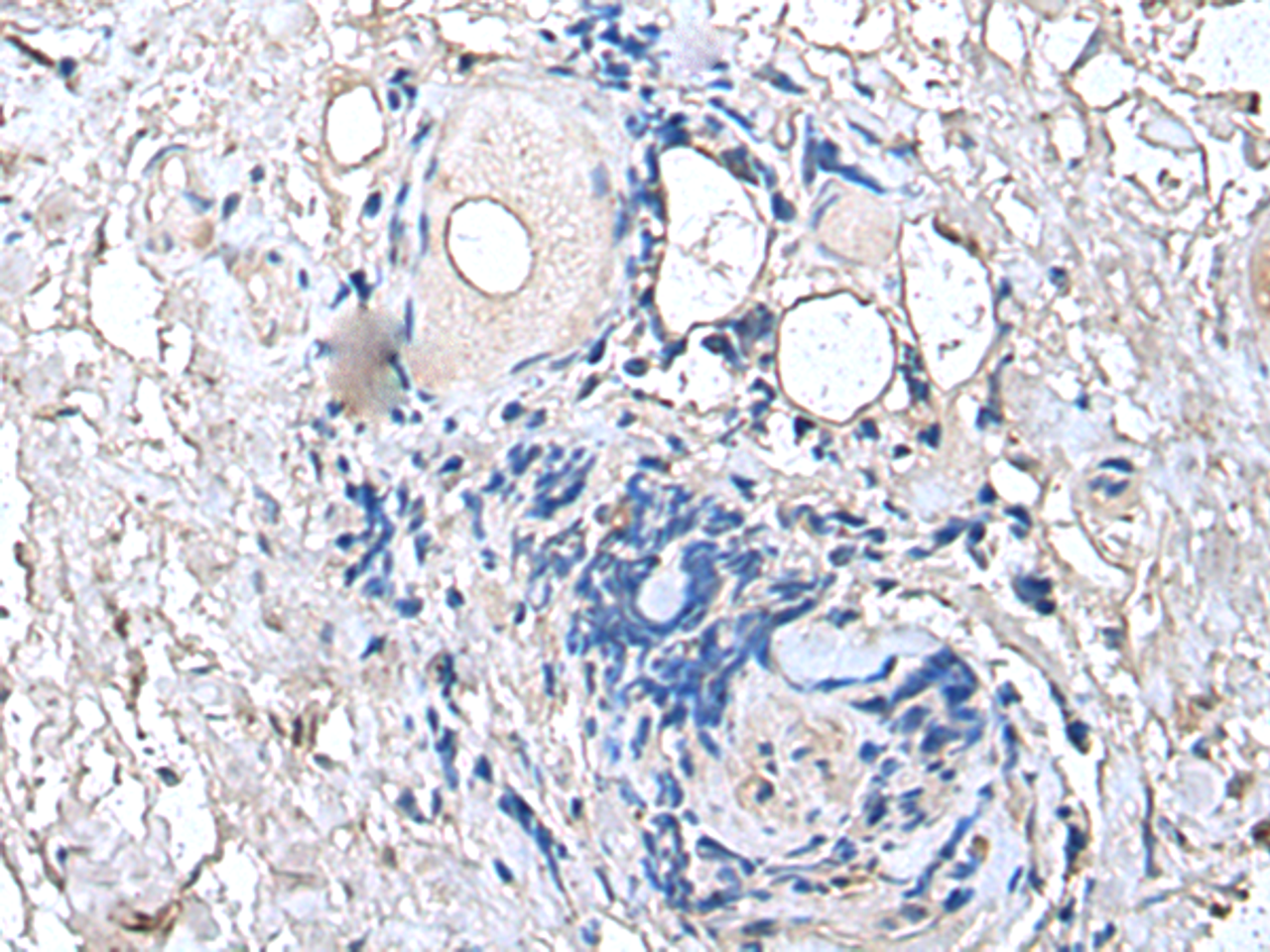 Immunohistochemistry of paraffin-embedded Human thyroid cancer tissue  using PTP4A1 Polyclonal Antibody at dilution of 1:45(×200)