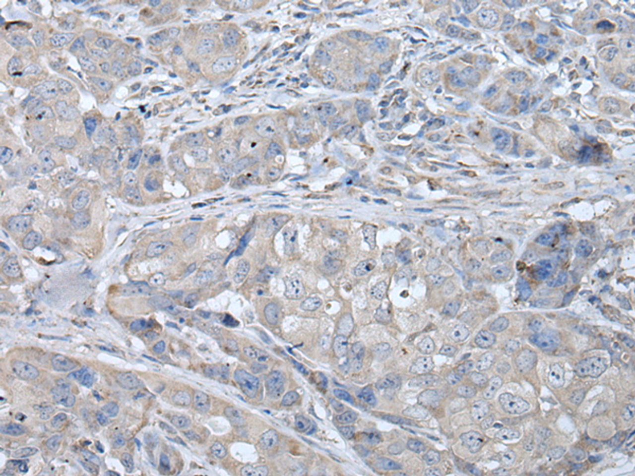 Immunohistochemistry of paraffin-embedded Human breast cancer tissue  using RASA1 Polyclonal Antibody at dilution of 1:40(×200)