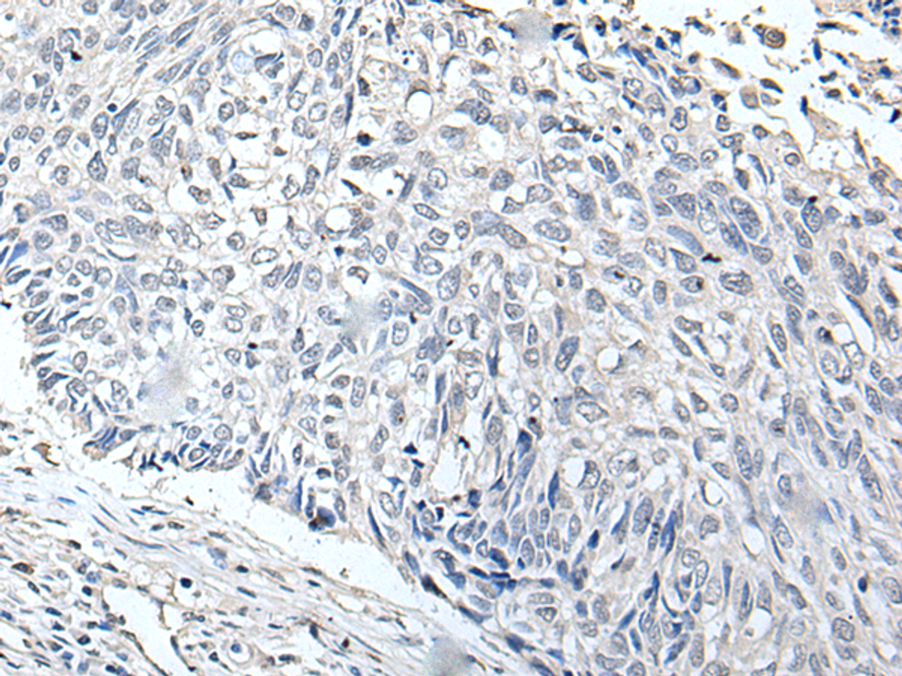 Immunohistochemistry of paraffin-embedded Human lung cancer tissue  using RERG Polyclonal Antibody at dilution of 1:65(×200)