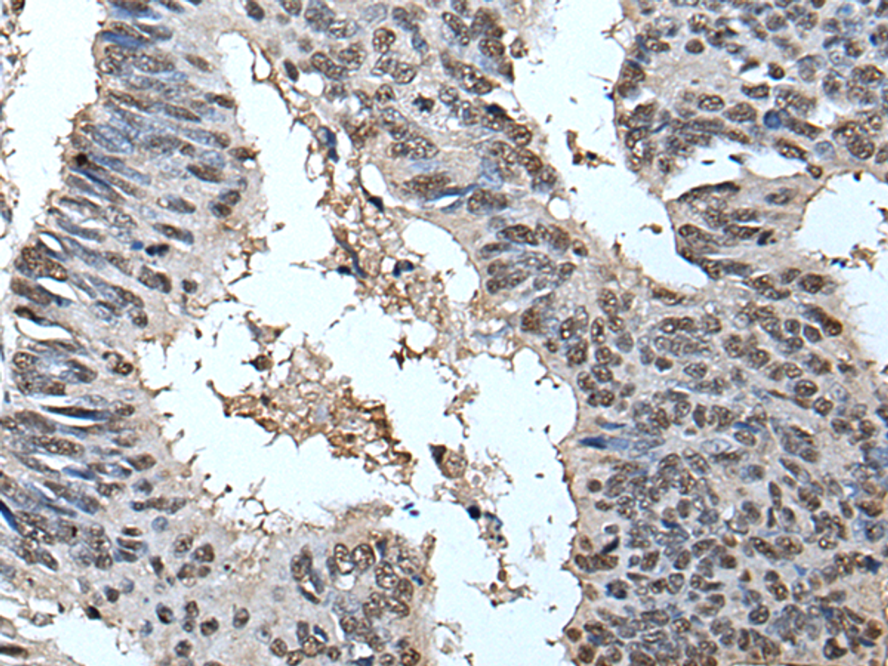 Immunohistochemistry of paraffin-embedded Human colorectal cancer tissue  using HELLS Polyclonal Antibody at dilution of 1:30(×200)