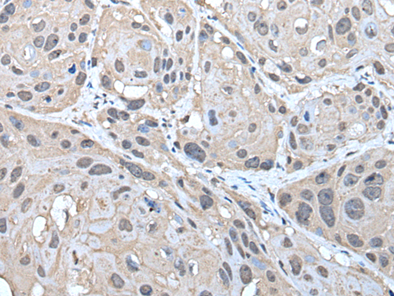 Immunohistochemistry of paraffin-embedded Human esophagus cancer tissue  using HELLS Polyclonal Antibody at dilution of 1:30(×200)