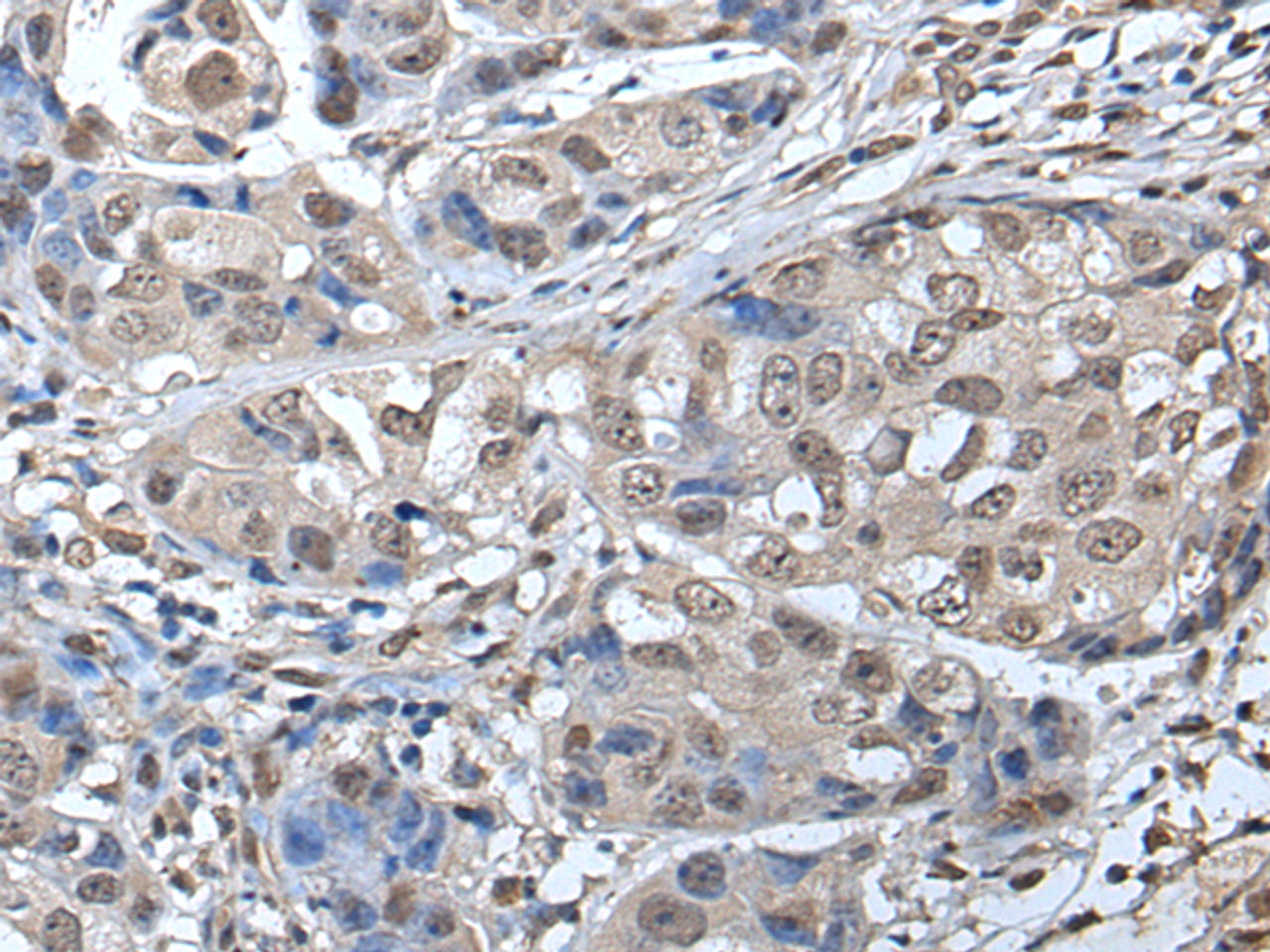 Immunohistochemistry of paraffin-embedded Human breast cancer tissue  using SMC1A Polyclonal Antibody at dilution of 1:45(×200)