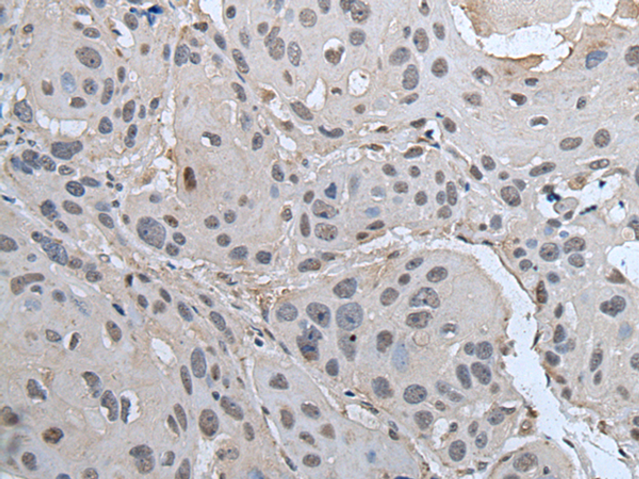 Immunohistochemistry of paraffin-embedded Human esophagus cancer tissue  using SMC1A Polyclonal Antibody at dilution of 1:45(×200)