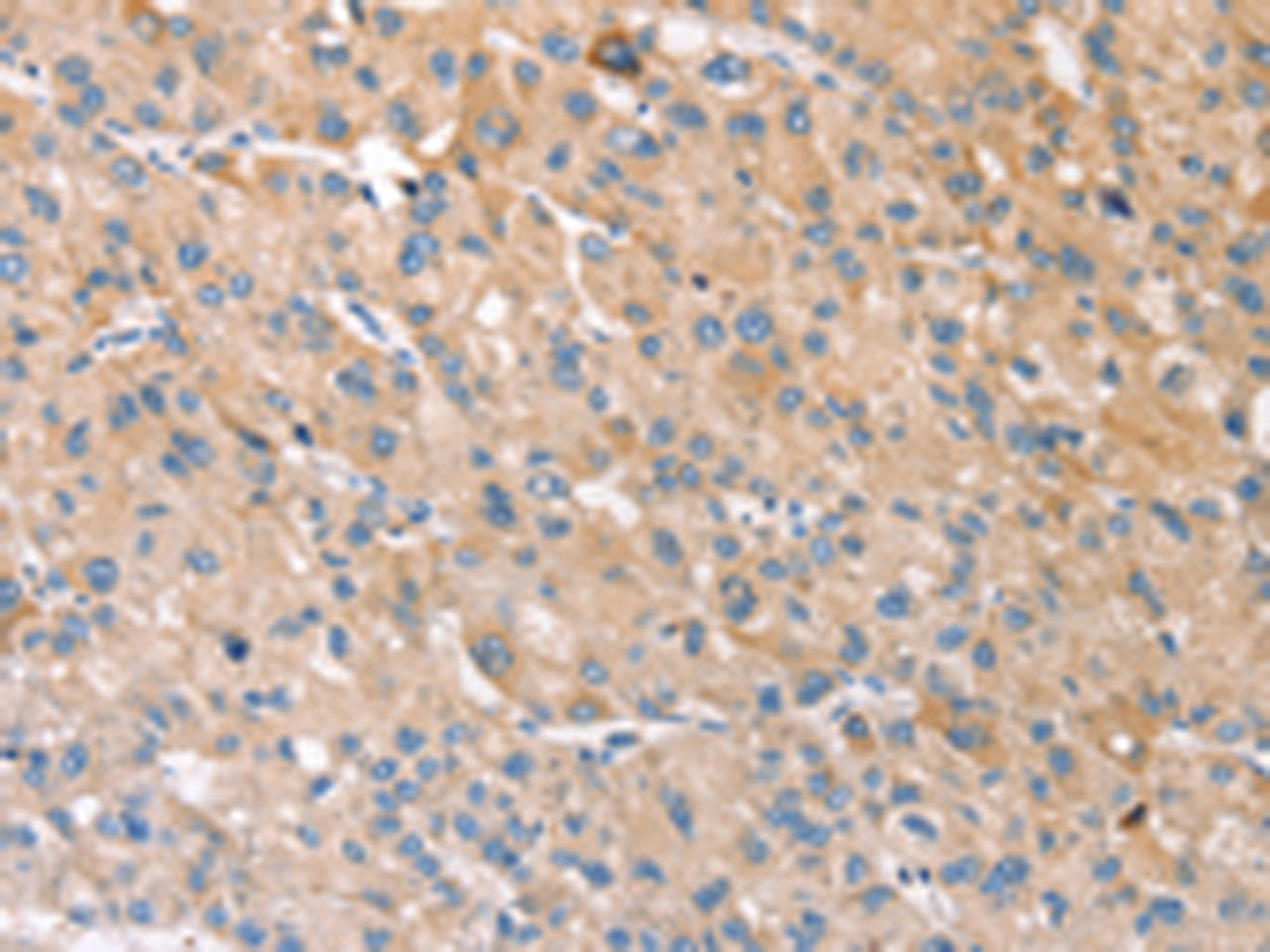 Immunohistochemistry of paraffin-embedded Human liver cancer tissue  using STK16 Polyclonal Antibody at dilution of 1:30(×200)