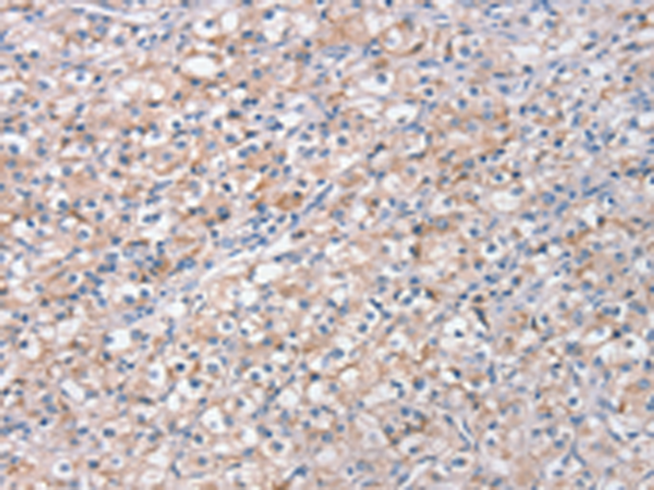 Immunohistochemistry of paraffin-embedded Human prost ate cancer tissue  using STK16 Polyclonal Antibody at dilution of 1:30(×200)