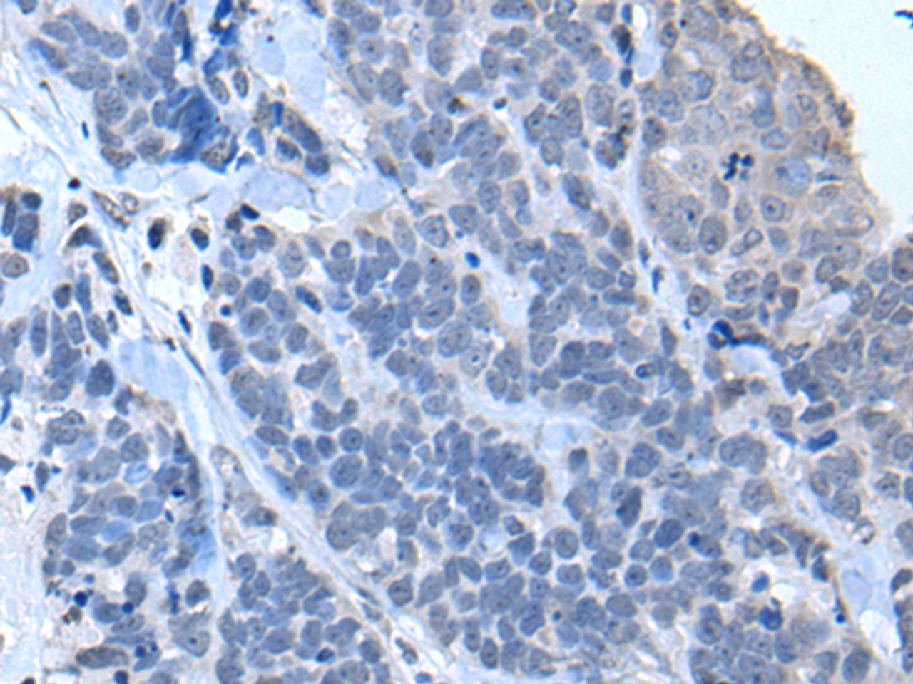 Immunohistochemistry of paraffin-embedded Human thyroid cancer tissue  using TIA1 Polyclonal Antibody at dilution of 1:30(×200)