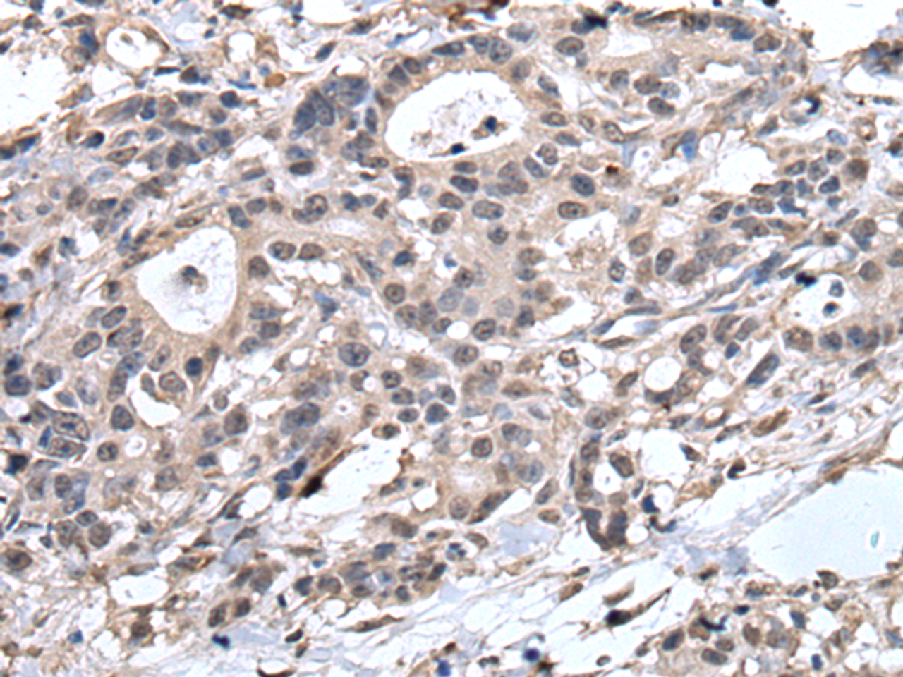 Immunohistochemistry of paraffin-embedded Human gastric cancer tissue  using TRIM27 Polyclonal Antibody at dilution of 1:65(×200)