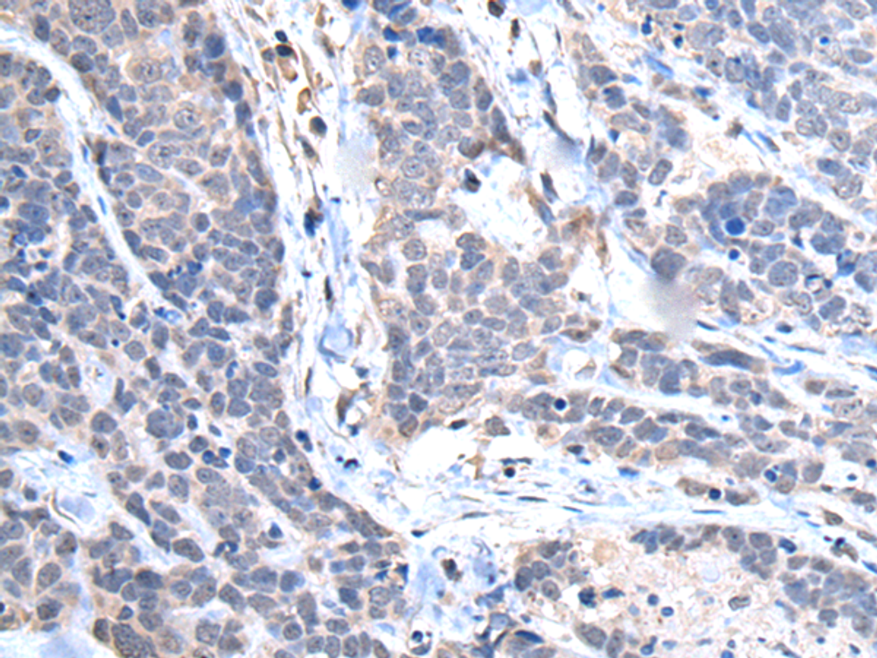 Immunohistochemistry of paraffin-embedded Human thyroid cancer tissue  using TRIM27 Polyclonal Antibody at dilution of 1:65(×200)