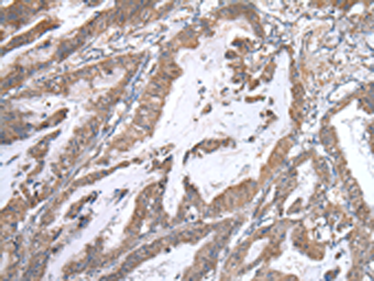 Immunohistochemistry of paraffin-embedded Human esophagus cancer tissue  using WWP1 Polyclonal Antibody at dilution of 1:40(×200)
