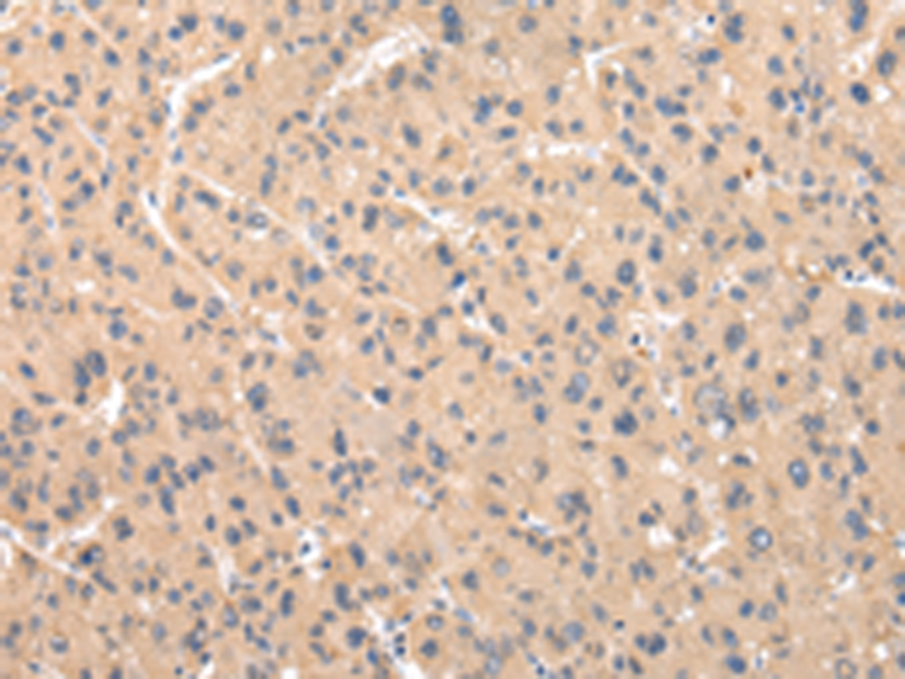 Immunohistochemistry of paraffin-embedded Human liver cancer tissue  using ZNF268 Polyclonal Antibody at dilution of 1:50(×200)