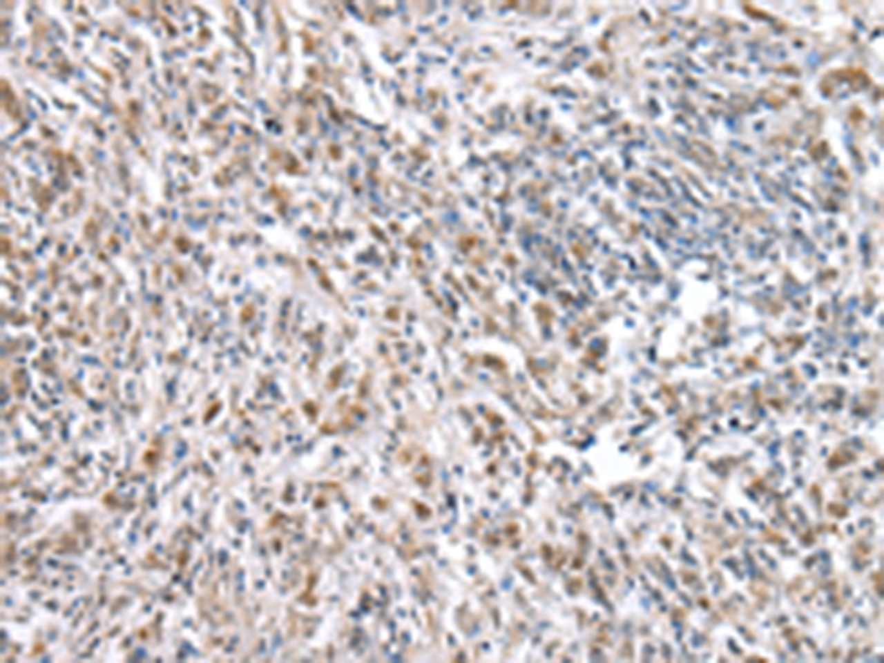 Immunohistochemistry of paraffin-embedded Human prost ate cancer tissue  using RNF115 Polyclonal Antibody at dilution of 1:45(×200)