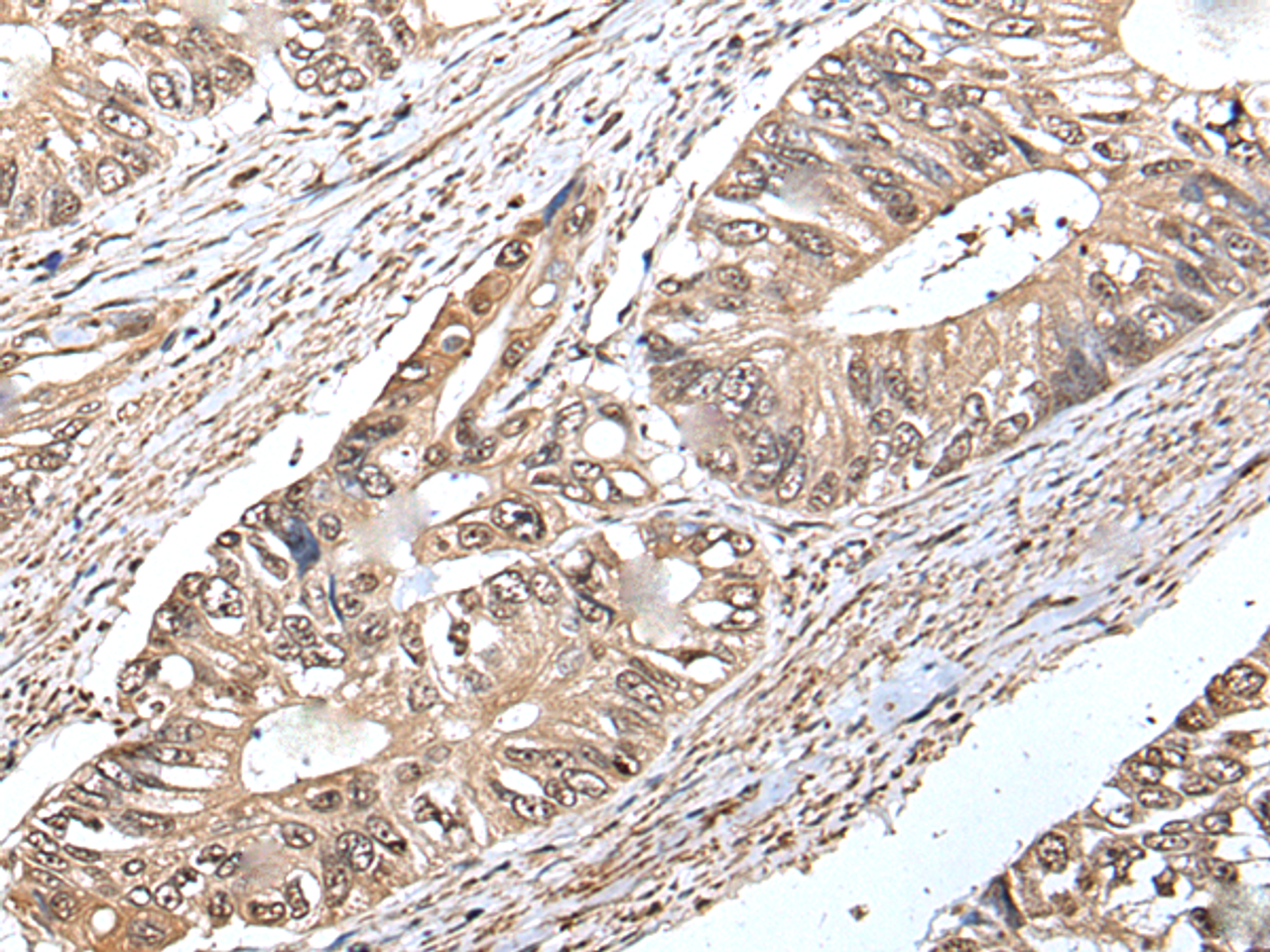 Immunohistochemistry of paraffin-embedded Human colorectal cancer tissue  using ATF6B Polyclonal Antibody at dilution of 1:30(×200)