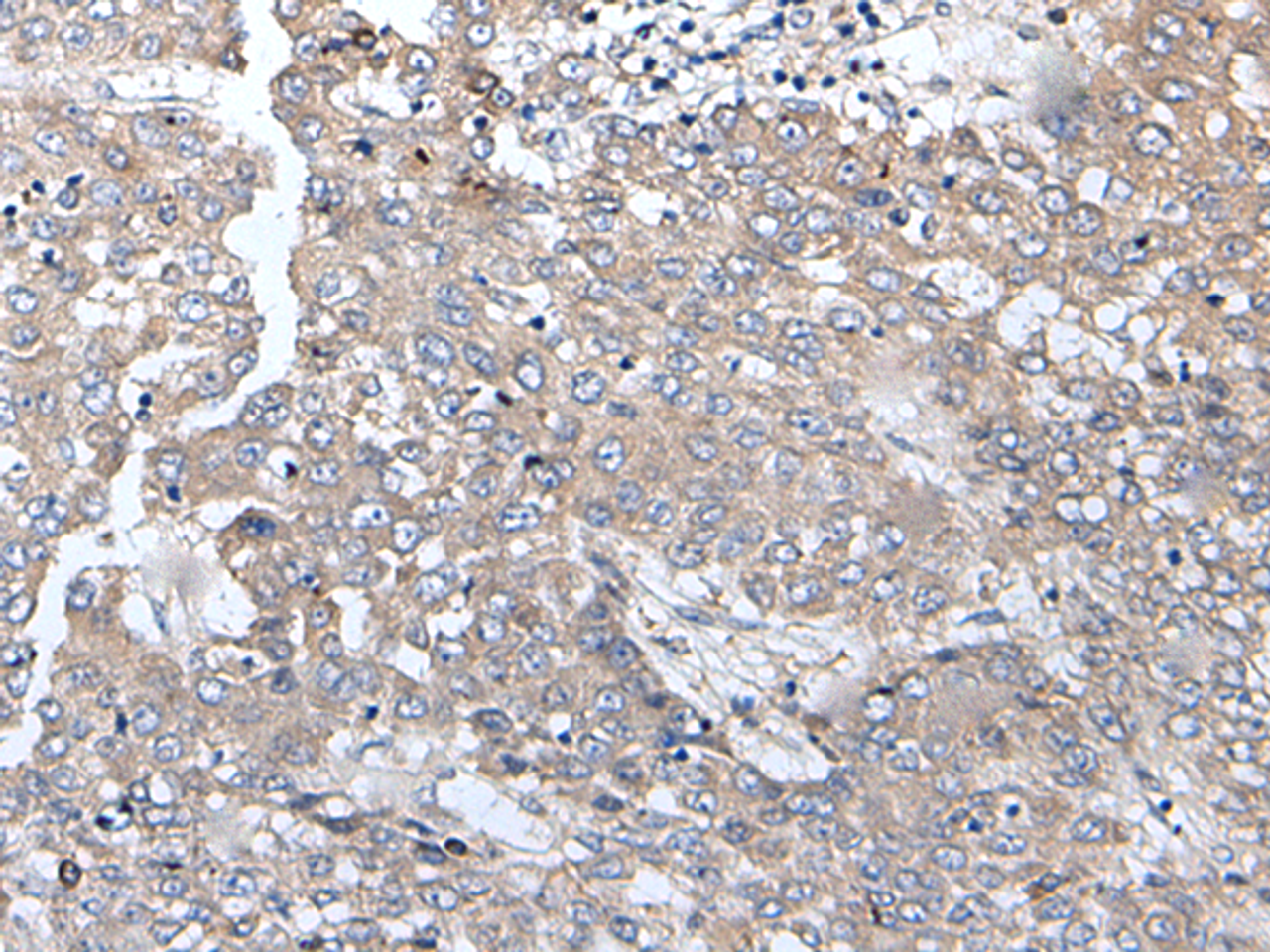 Immunohistochemistry of paraffin-embedded Human liver cancer tissue  using BRMS1L Polyclonal Antibody at dilution of 1:45(×200)