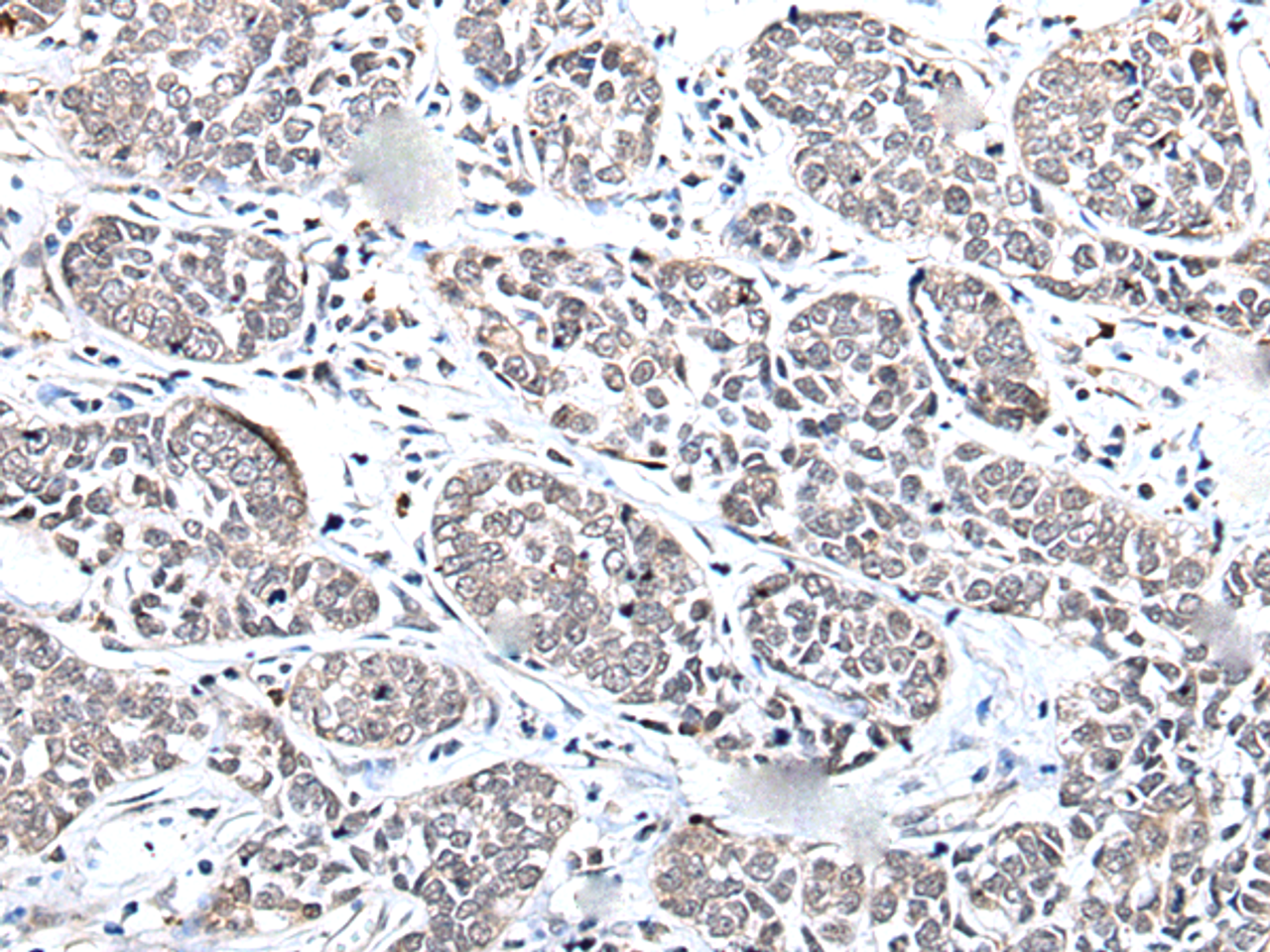 Immunohistochemistry of paraffin-embedded Human esophagus cancer tissue  using BRMS1L Polyclonal Antibody at dilution of 1:45(×200)