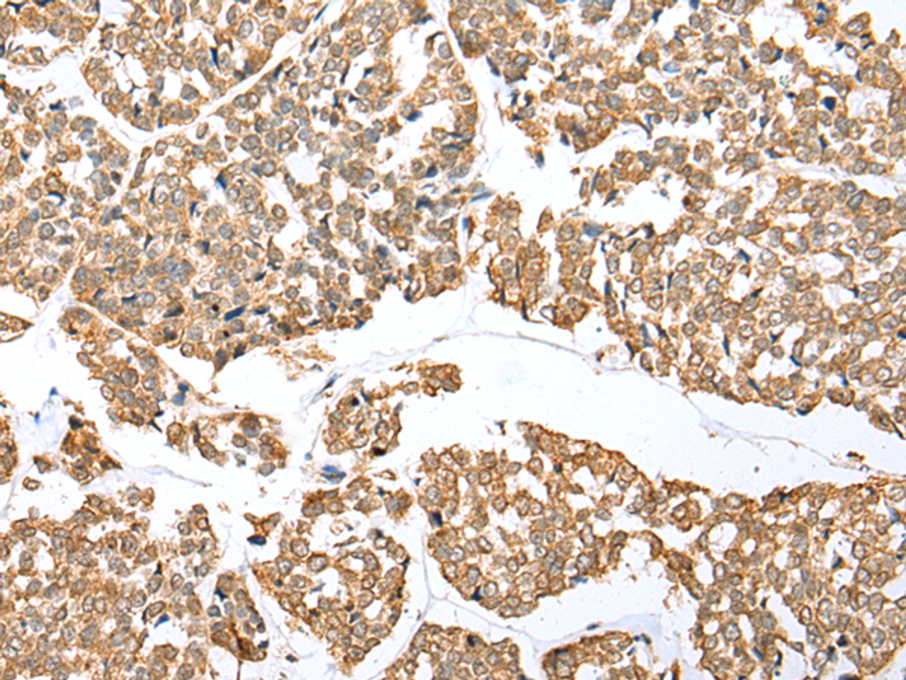 Immunohistochemistry of paraffin-embedded Human esophagus cancer tissue  using NDUFB3 Polyclonal Antibody at dilution of 1:25(×200)