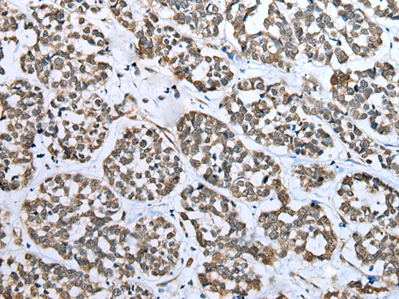 Immunohistochemistry of paraffin-embedded Human esophagus cancer tissue  using CARTPT Polyclonal Antibody at dilution of 1:25(×200)