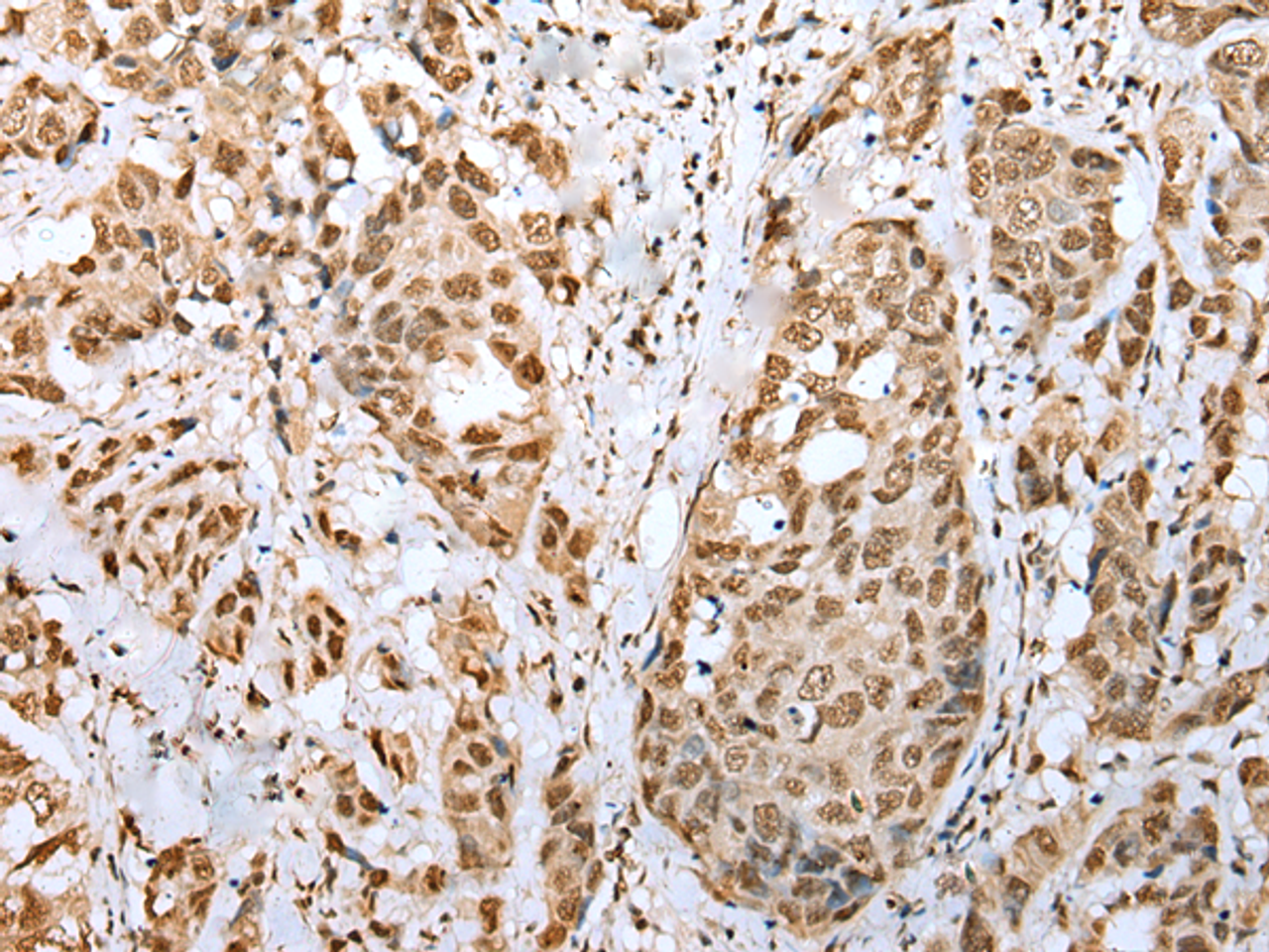 Immunohistochemistry of paraffin-embedded Human breast cancer tissue  using ZNF486 Polyclonal Antibody at dilution of 1:50(×200)