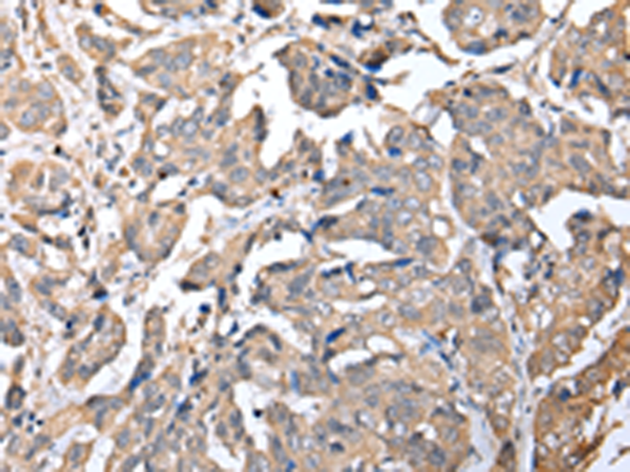 Immunohistochemistry of paraffin-embedded Human breast cancer tissue  using KCTD16 Polyclonal Antibody at dilution of 1:25(×200)