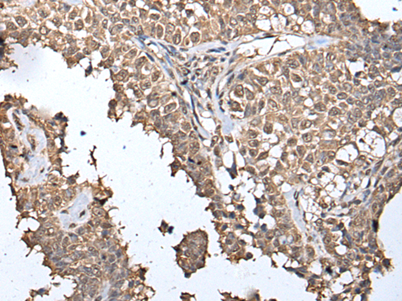 Immunohistochemistry of paraffin-embedded Human ovarian cancer tissue  using METAP1D Polyclonal Antibody at dilution of 1:40(×200)