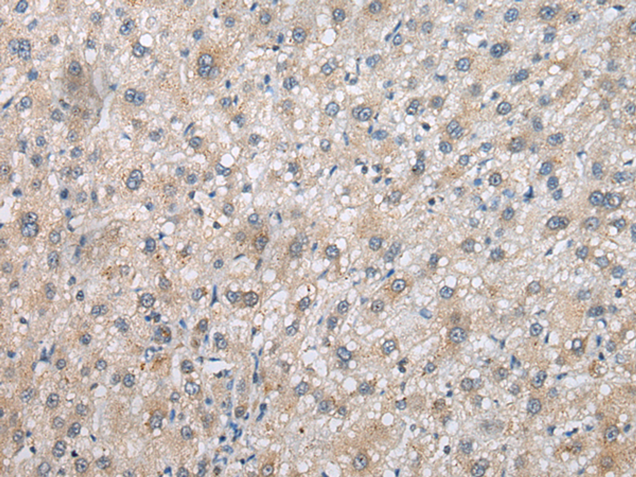 Immunohistochemistry of paraffin-embedded Human liver cancer tissue  using PSMF1 Polyclonal Antibody at dilution of 1:30(×200)