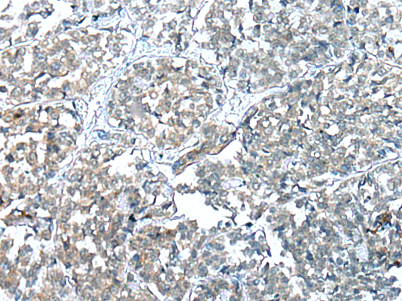 Immunohistochemistry of paraffin-embedded Human esophagus cancer tissue  using COMMD6 Polyclonal Antibody at dilution of 1:45(×200)