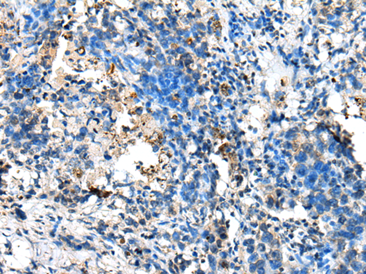 Immunohistochemistry of paraffin-embedded Human lung cancer tissue  using NUDT10 Polyclonal Antibody at dilution of 1:70(×200)