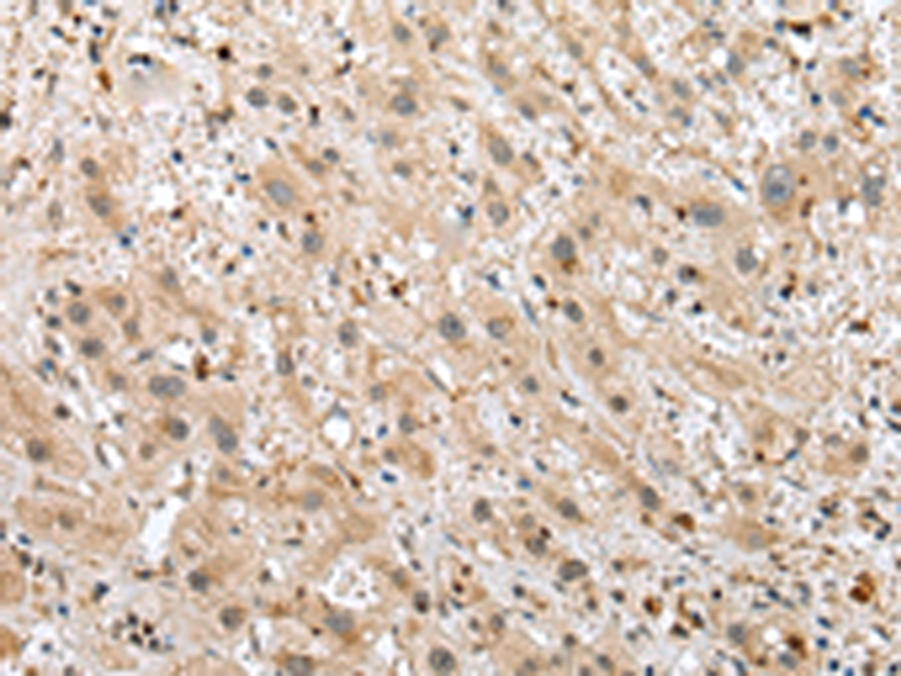 Immunohistochemistry of paraffin-embedded Human liver cancer tissue  using TPPP Polyclonal Antibody at dilution of 1:25(×200)
