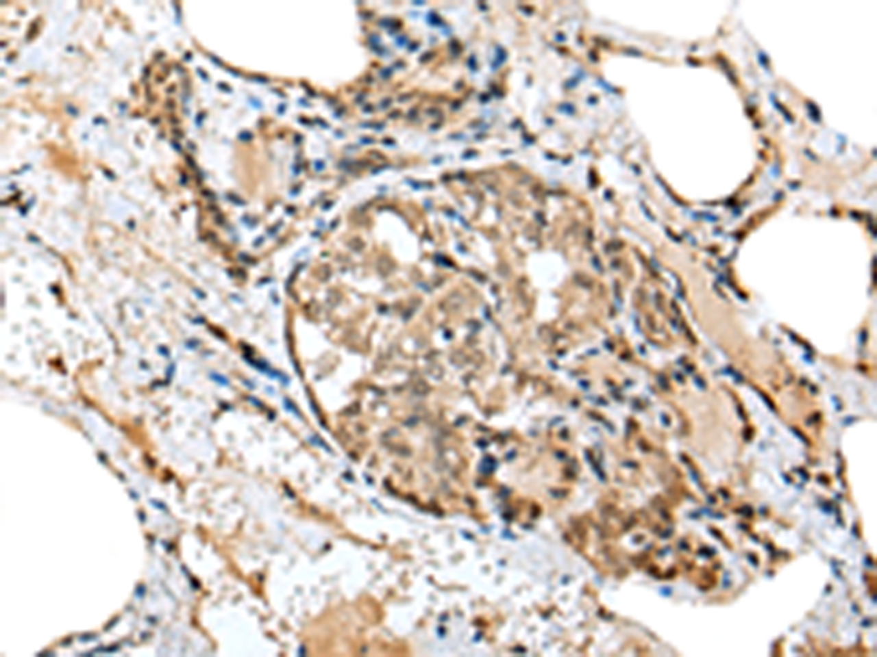 Immunohistochemistry of paraffin-embedded Human thyroid cancer tissue  using TPPP Polyclonal Antibody at dilution of 1:25(×200)